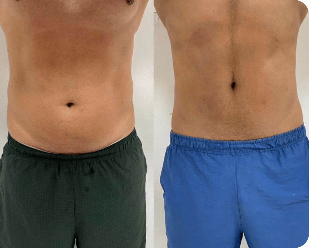 Resultado de tratamento corporal Splendore