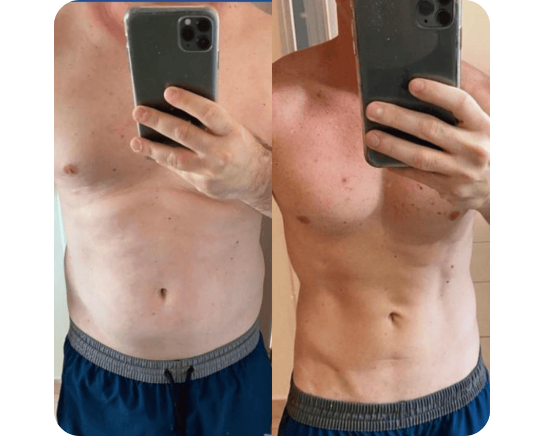 Resultado tratamento corporal