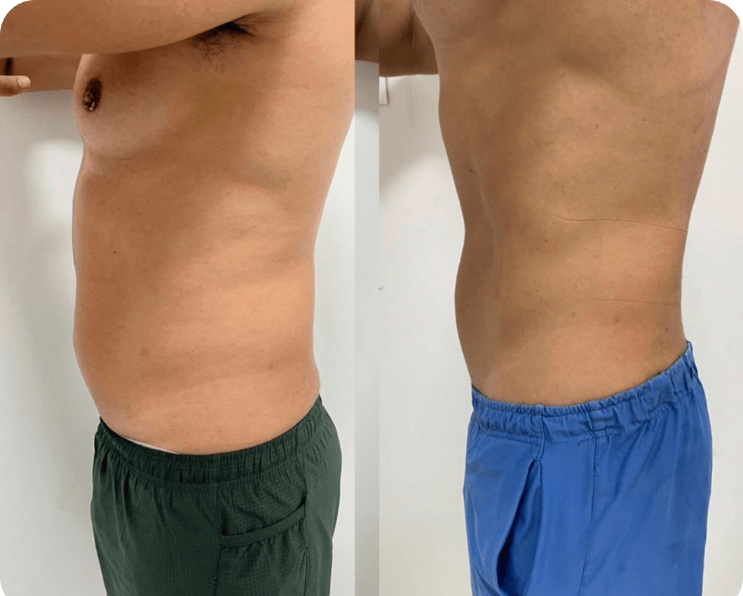 Resultado tratamento corporal