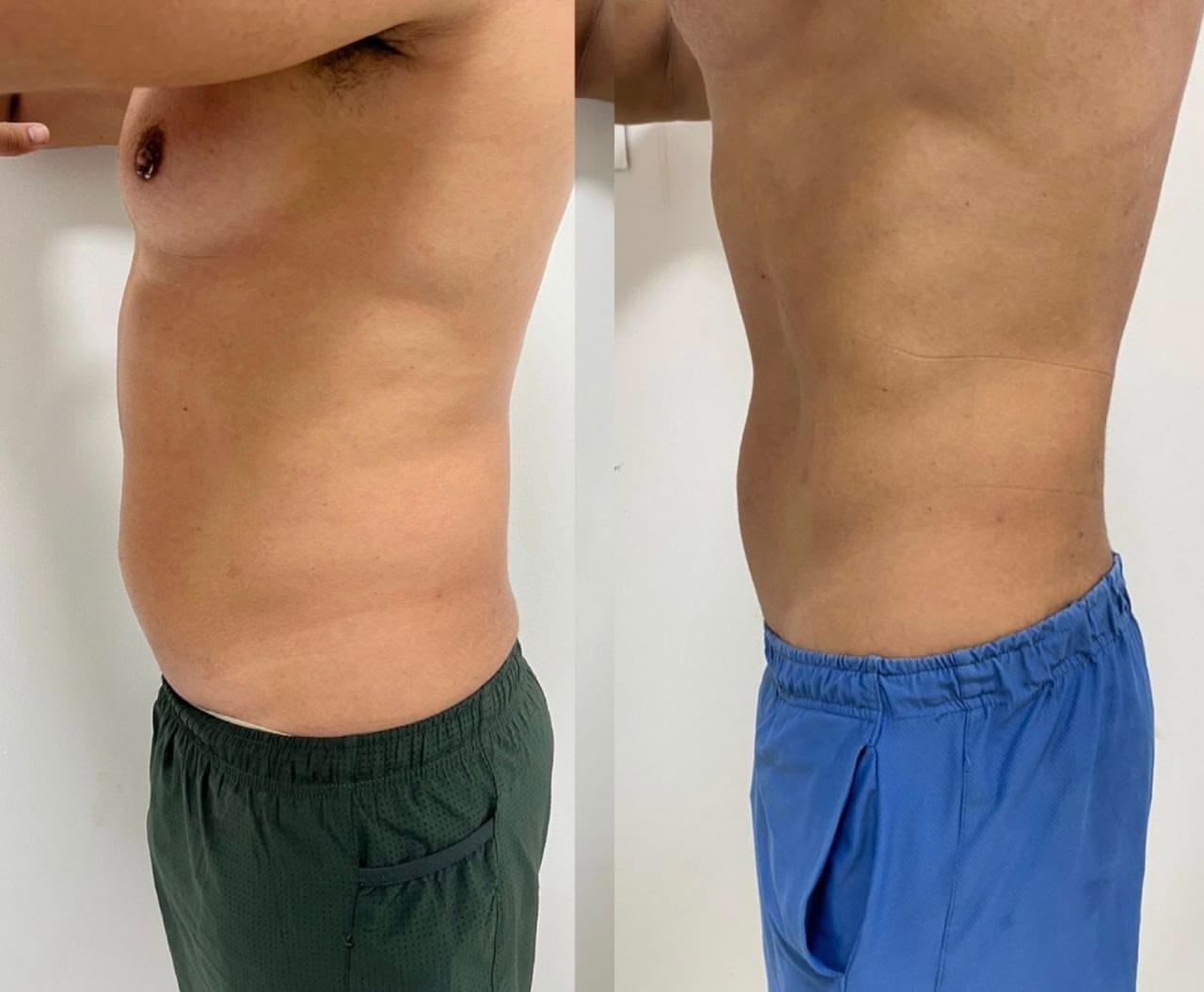 Resultado tratamento corporal