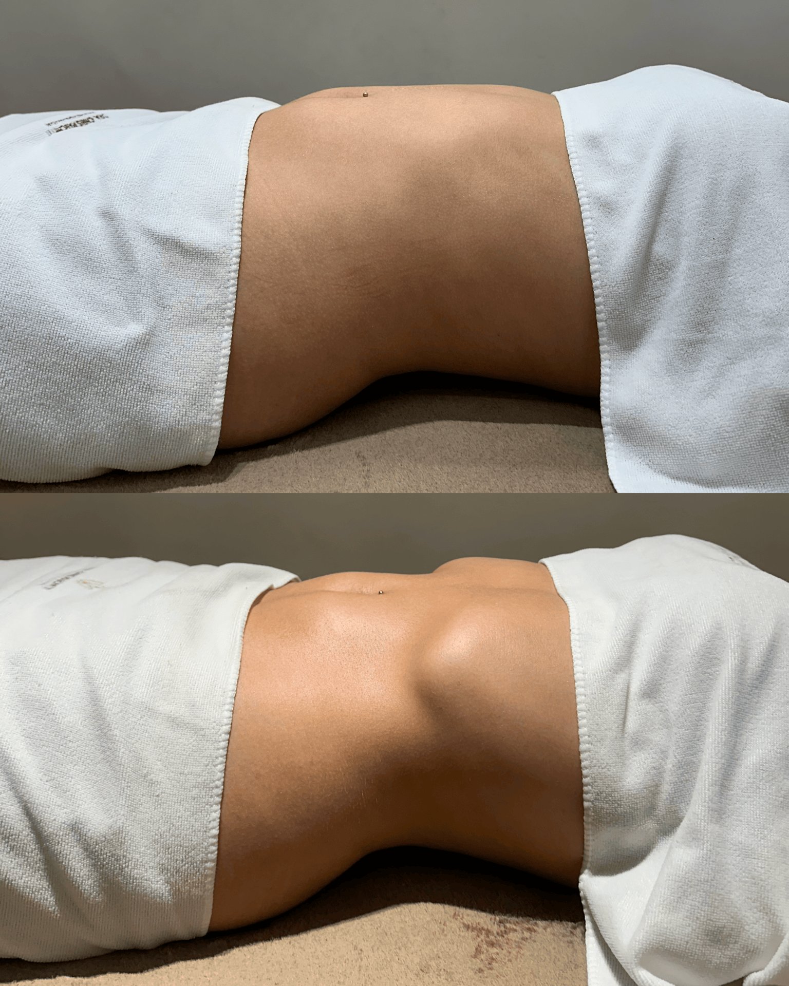 Resultado tratamento corporal